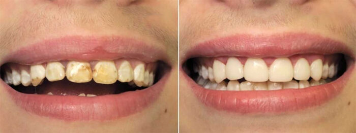 Почему появляются темные пятна на передних зубах?